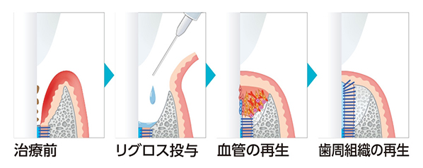 リグロスによる歯周組織の再生の流れ